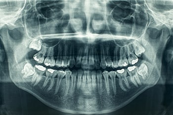 Dental X-rays