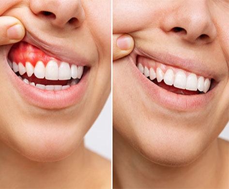 Gum Disease Gingivitis